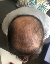 PURC-pulverizador para el crecimiento del cabello para hombres y mujeres, tratamiento para la pérdida de cabello de rápido crecimiento, productos de belleza para el cuidado del cabello, 30ml