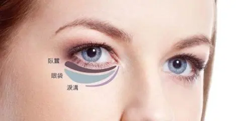 眼袋的治疗方法 针灸治疗眼袋效果-养生法典