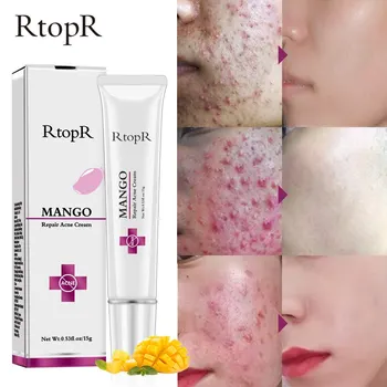 

Mango Repair Cream Anti Acne Spots Acne Treatment Scar Blackhead Cream Shrink Pores Whitening Moisturizing Face Skin Care 15g