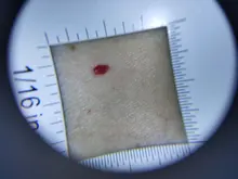 Lupa con mango de dermatoscopio 10X, visión clara suave con escala de medida, 30X, tipo B, visión más grande con luz UV