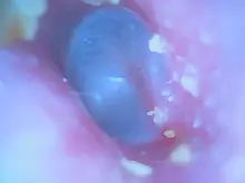 HD 1080P 3,9mm Digital de oído otoscopio 2.0MP WiFi oído Cámara endoscopio cera herramientas de eliminación de boroscopio de herramienta de limpieza del oído