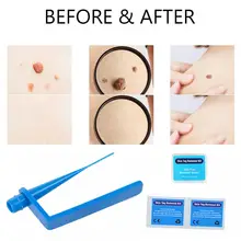 Micro Band Skin tag remover Skin Tag Removal Kit With Cleansing Swabs Mole Wart Face Skin Care Beauty Tools  For Home Use