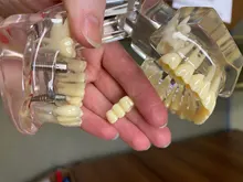 Modelo de dientes para implante Dental, modelo transparente para dentistas, estudiantes de aprendizaje, enseñanza, comunicación de investigación